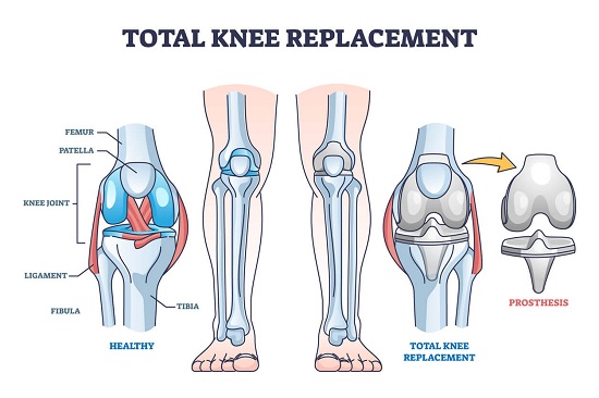 Knee Replacement Surgery 