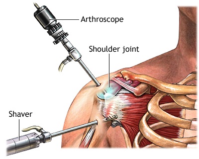shoulder surgery