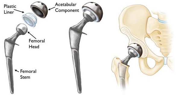 Hip Replacement Surgery